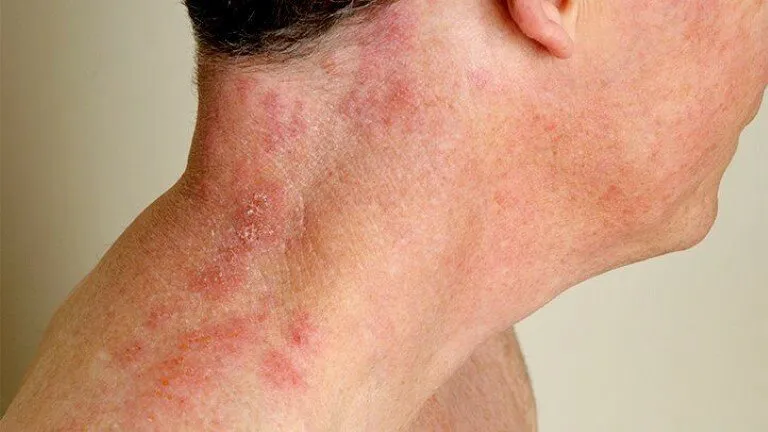 Zona thần kinh, phòng ngừa và điều trị qua hình ảnh 19