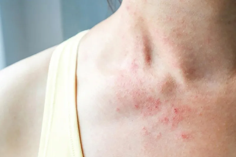 Zona thần kinh, phòng ngừa và điều trị qua hình ảnh 20