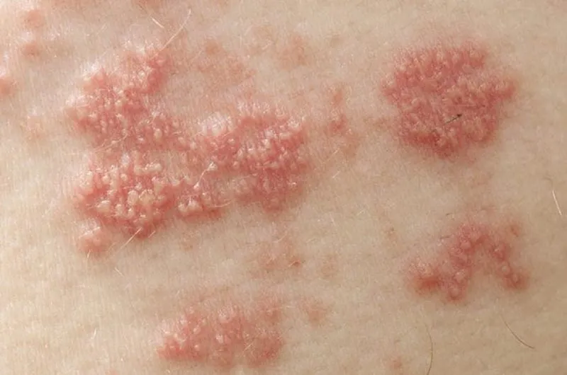 Zona thần kinh, phòng ngừa và điều trị qua hình ảnh 21