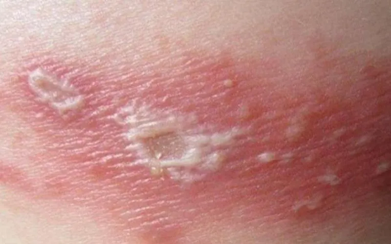 Zona thần kinh, phòng ngừa và điều trị qua hình ảnh 22