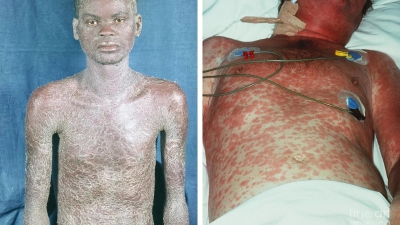 Minh họa bệnh AIDS có lây không qua các con đường truyền nhiễm