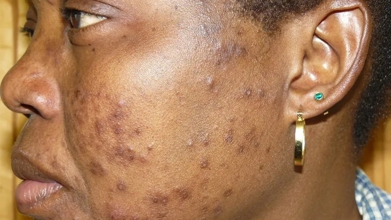 Biểu hiện hình ảnh HIV giai đoạn cuối với các bệnh nhiễm trùng cơ hội