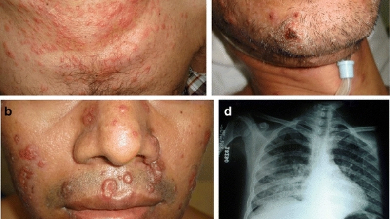 Sơ đồ các giai đoạn của bệnh AIDS từ nhiễm HIV đến toàn phát