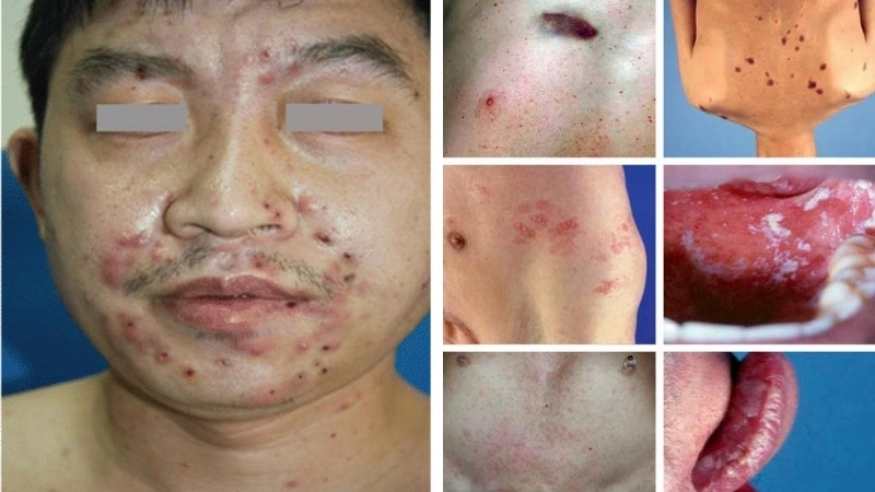 Quy trình xét nghiệm HIV chẩn đoán chính xác tình trạng nhiễm