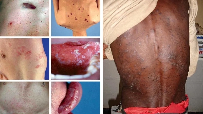 Tác dụng của thuốc ARV trong kiểm soát virus HIV