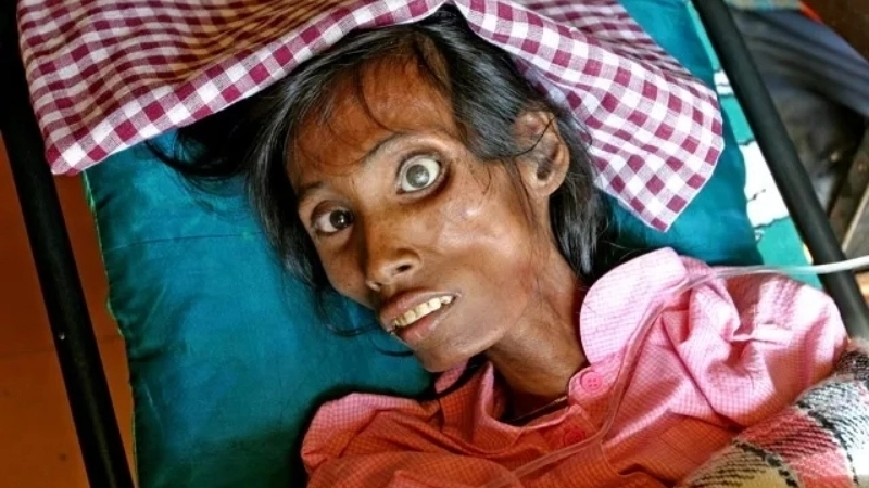 Chân dung hình ảnh người bị AIDS giai đoạn nặng