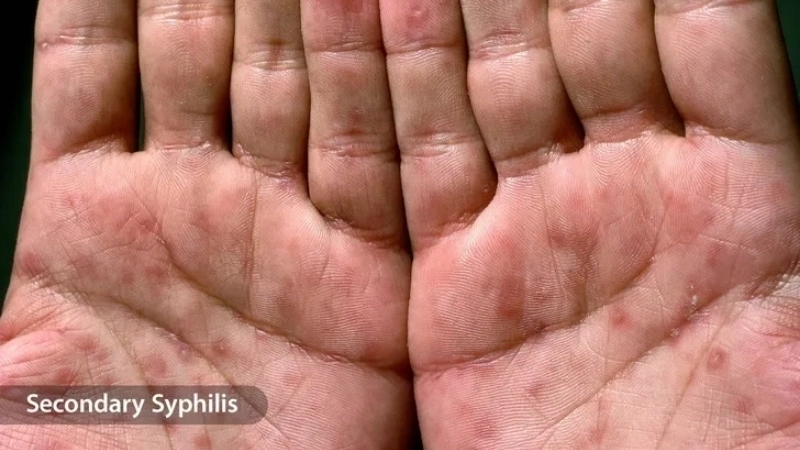 Hình ảnh triệu chứng HIV giai đoạn đầu dễ bị bỏ qua