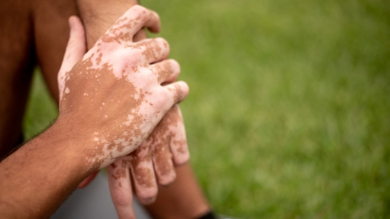 So sánh trực quan để phân biệt lang ben và bạch biến