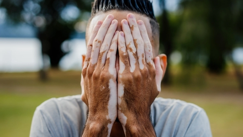 Các loại thuốc bôi bạch biến được bác sĩ chỉ định