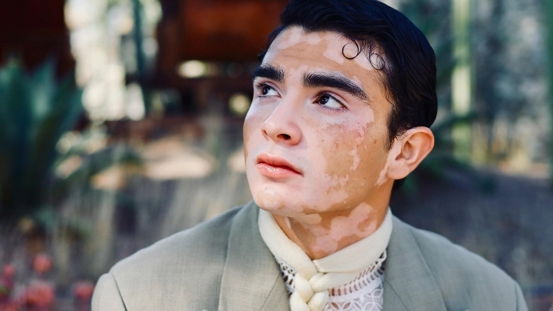 Thảo luận bệnh bạch biến có nguy hiểm không qua hình ảnh thực tế