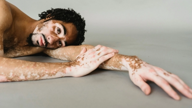 Quá trình phục hồi sắc tố da sau khi điều trị thành công