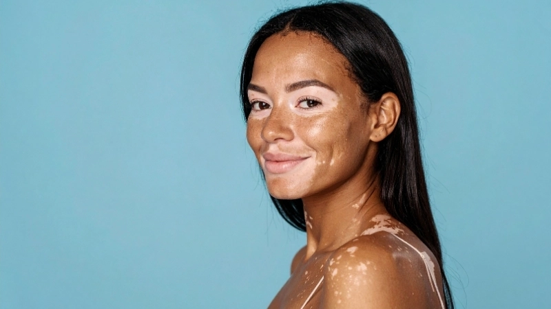 Dấu hiệu bệnh bạch biến đặc trưng với các mảng da mất sắc tố có ranh giới rõ rệt.