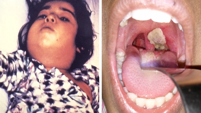 Lịch tiêm vắc xin bạch hầu đầy đủ cho mọi lứa tuổi