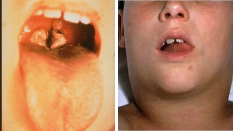 So sánh họng bình thường và họng khi có giả mạc bạch hầu