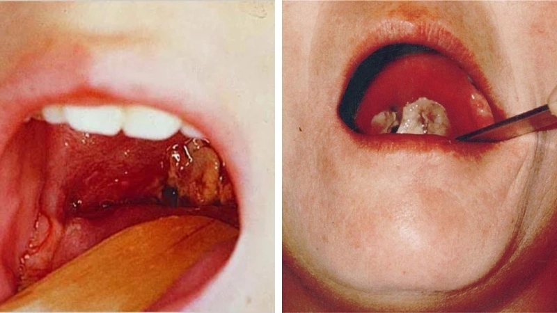 Hình ảnh giả mạc bạch hầu đặc trưng trong cổ họng