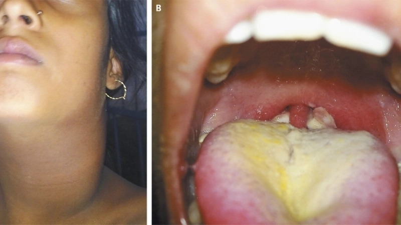 Bệnh bạch hầu có nguy hiểm không qua hình ảnh biến chứng tim