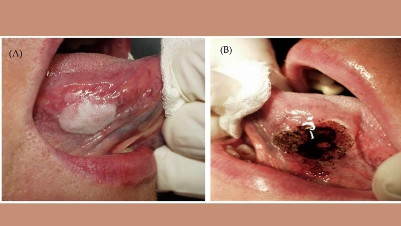 Hình ảnh so sánh bệnh bạch sản và nấm lưỡi