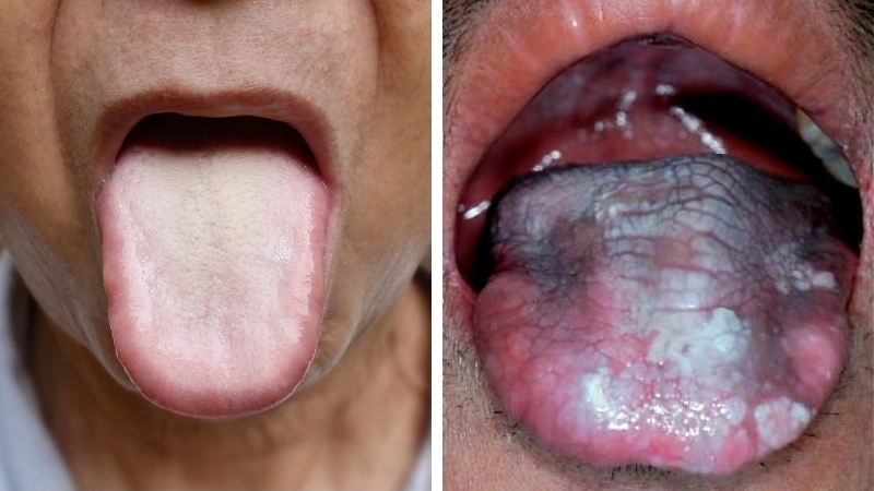 Dấu hiệu cảnh báo mối liên hệ bạch sản và ung thư