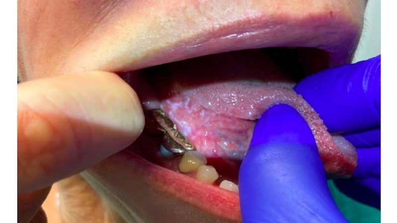 Hình ảnh minh họa nguyên nhân bệnh bạch sản do thuốc lá