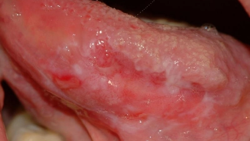 Cận cảnh triệu chứng bạch sản lưỡi ở niêm mạc má