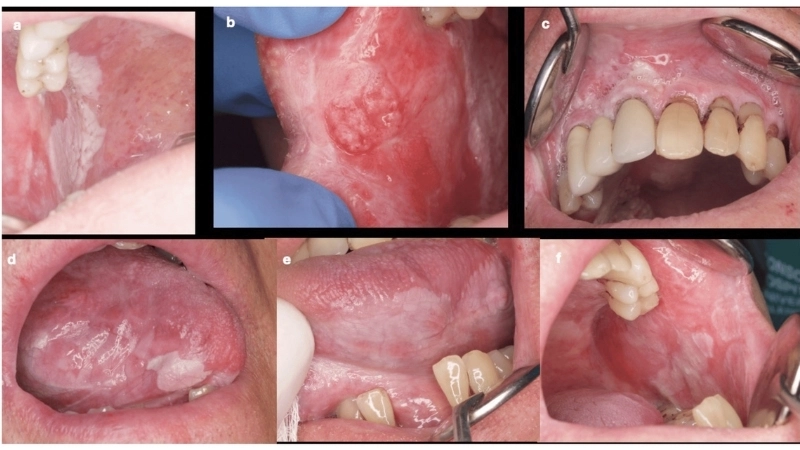 Hình ảnh bạch sản dạng lông để hiểu rõ hơn bệnh bạch sản là gì