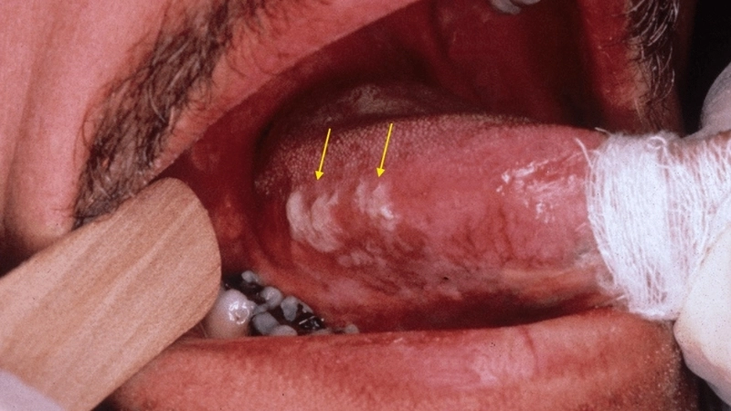 Hình ảnh tổn thương hồng sản, nguy cơ cao của ung thư