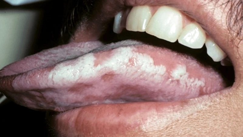 Hiểu rõ bệnh bạch sản là gì qua hình ảnh tổn thương mảng trắng điển hình.