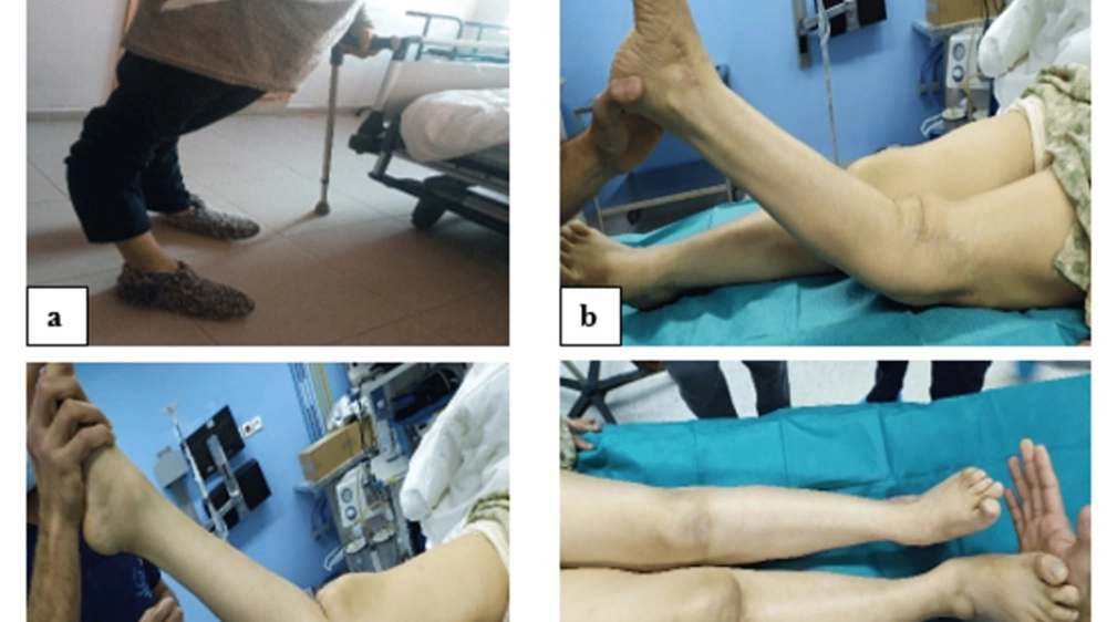 Tầm quan trọng của vắc xin bại liệt trong y tế toàn cầu