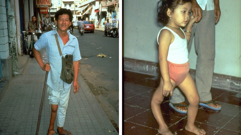 Hình ảnh di chứng bệnh bại liệt ở chân, nhấn mạnh tầm quan trọng của việc tiêm chủng đầy đủ.