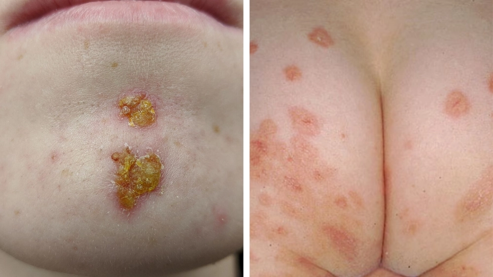 Giải đáp y khoa: Bệnh canh châu là gì?