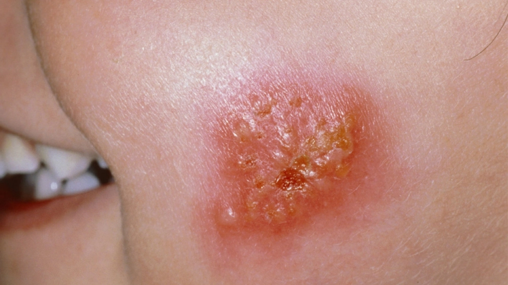 Tổn thương do bệnh hoại tử vùng miệng