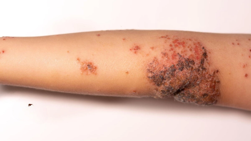 Hình ảnh vi khuẩn Fusobacterium necrophorum