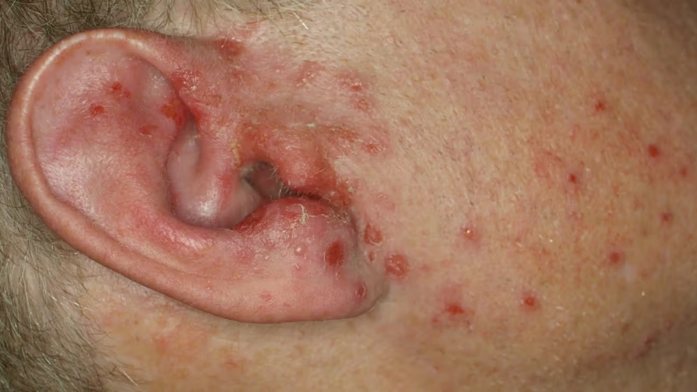 Vệ sinh răng miệng giúp phòng ngừa bệnh canh châu