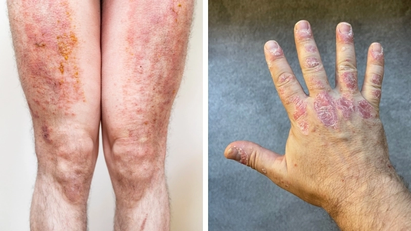 Lựa chọn thuốc bôi chàm đỉa phù hợp với từng giai đoạn