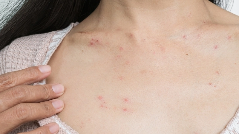 Cận cảnh bệnh chàm khô đầu ngón tay nứt nẻ