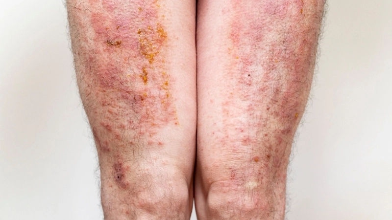 Cận cảnh bệnh chàm khô đầu ngón tay nứt nẻ