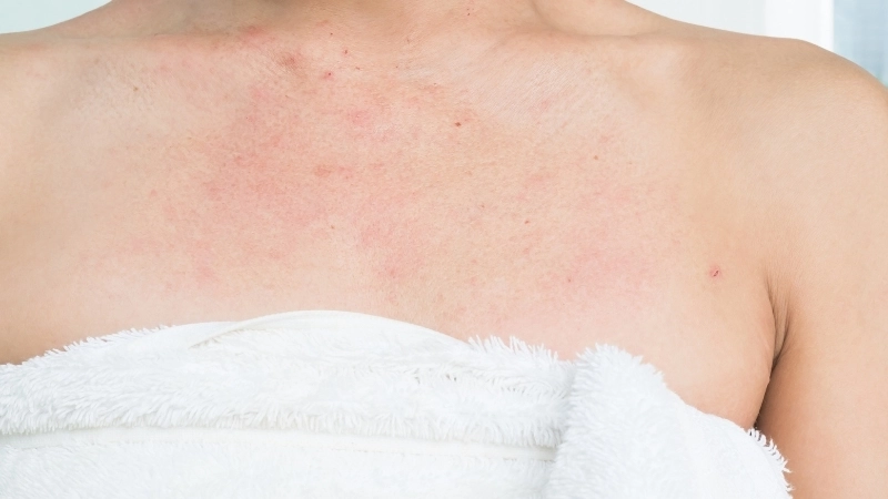 Hình ảnh bệnh chàm khô với các mảng da bong tróc