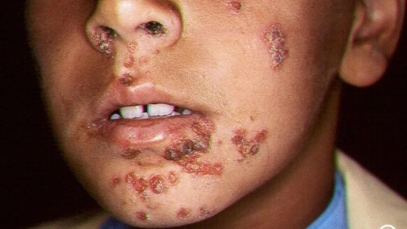 Giải đáp bệnh chốc lở có lây không qua tiếp xúc da kề da