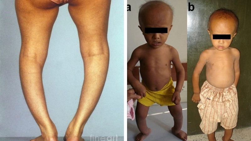 Dấu hiệu trẻ bị còi xương chân vòng kiềng