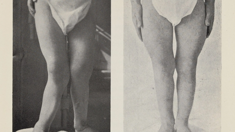 Quy trình xét nghiệm bệnh còi xương tại bệnh viện