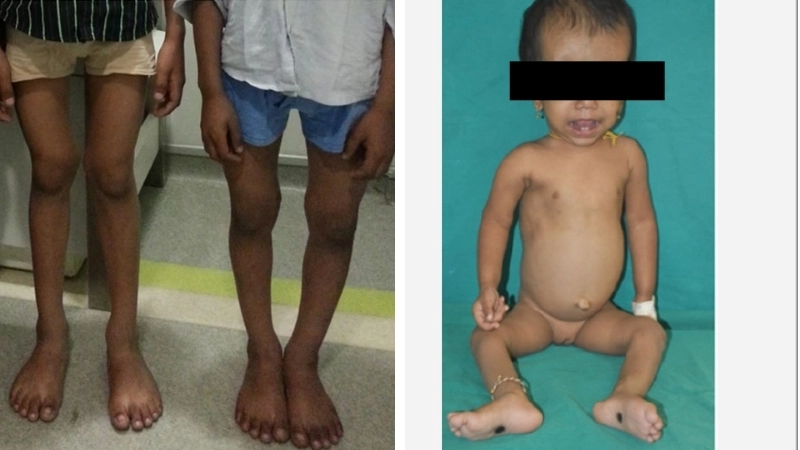 Hình ảnh X-quang biến dạng xương do còi xương
