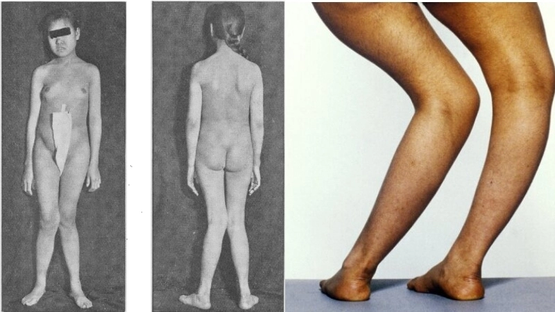 Chuỗi hạt sườn là một dấu hiệu còi xương điển hình