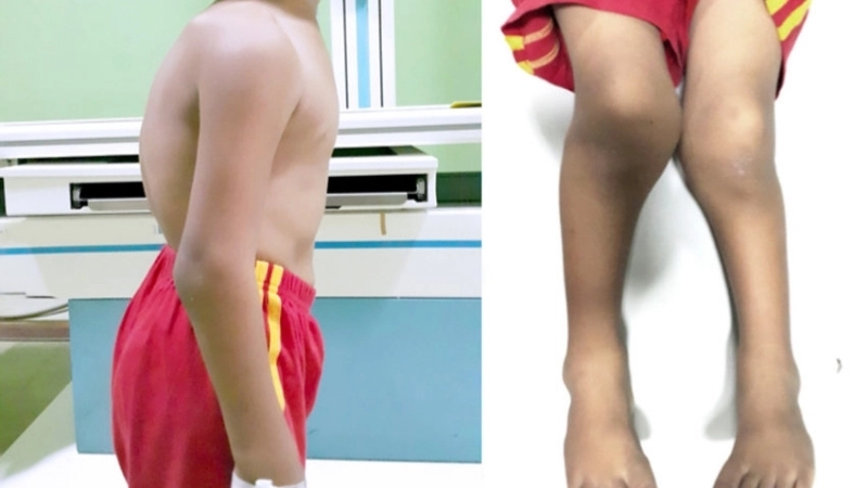 Dấu hiệu rụng tóc vành khăn ở trẻ sơ sinh nghi ngờ còi xương