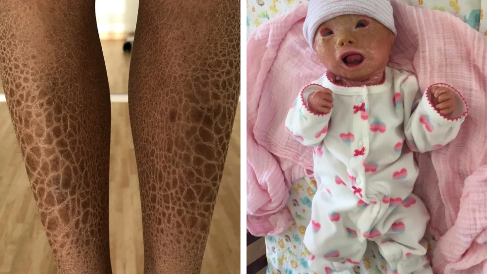 Hướng dẫn cách chữa bệnh da rắn tại nhà