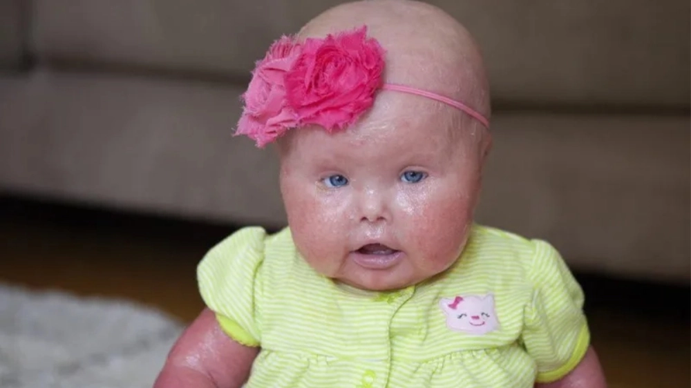 Các triệu chứng bệnh da rắn trên da