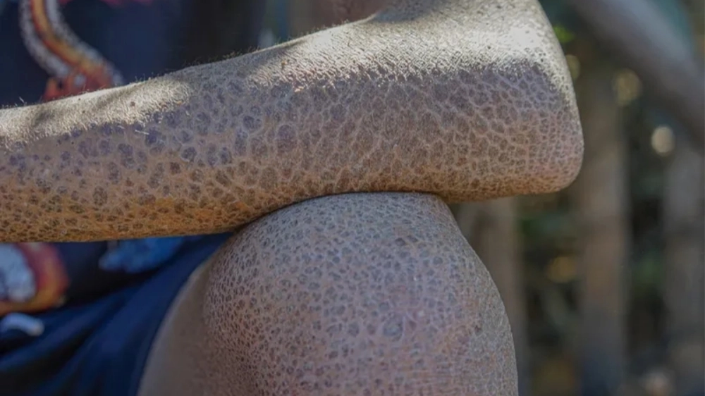 Biểu hiện của bệnh Ichthyosis Vulgaris