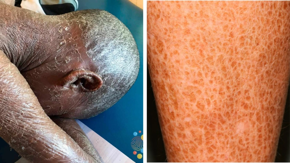 Sử dụng thuốc bôi bệnh da rắn đúng cách