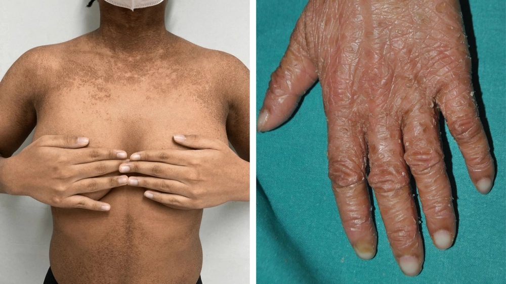 Chăm sóc da cho người bị bệnh vảy cá