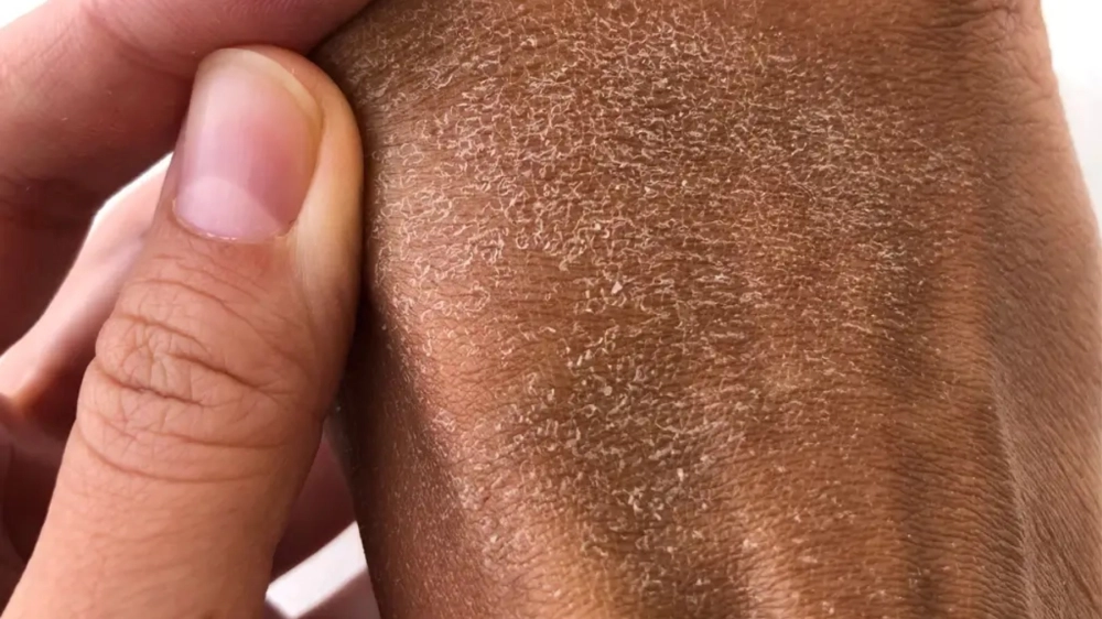 Hình ảnh bệnh da rắn ở trẻ em