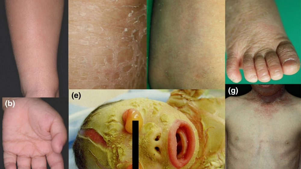 Bệnh vảy cá da rắn là một rối loạn di truyền phổ biến.